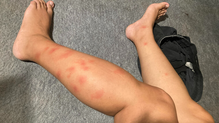 Soothe Painful Bug Bites